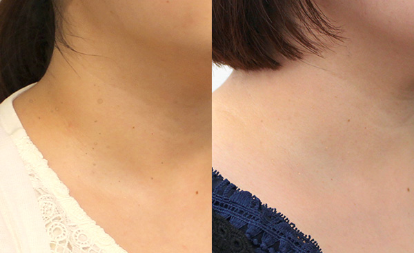 アンミオイル使用前・使用後の変化